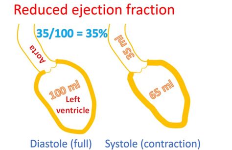 What Is Heart Failure With Reduced Ejection Fraction All About Heart