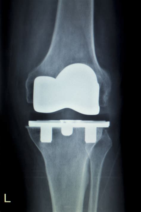 Orthopedic Knee Implant Xray Scan Foundation For Orthopaedic Research