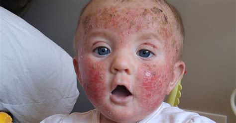 Mums Warning As Baby With Extreme Eczema Screams Like Shes On Fire