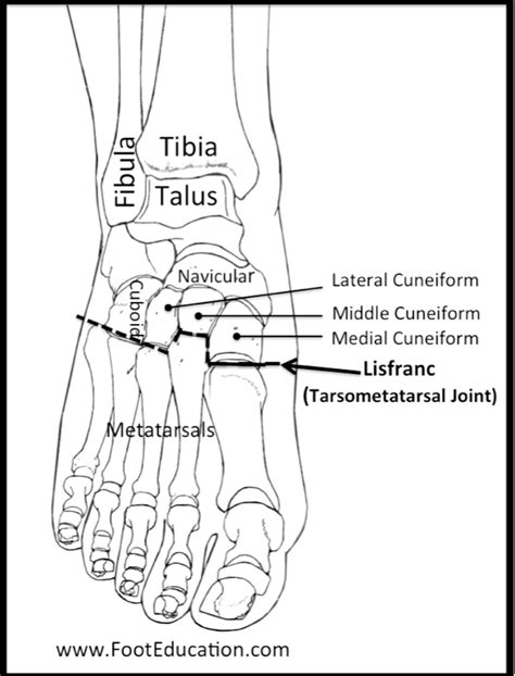 Lisfranc Fracture Orif Footeducation