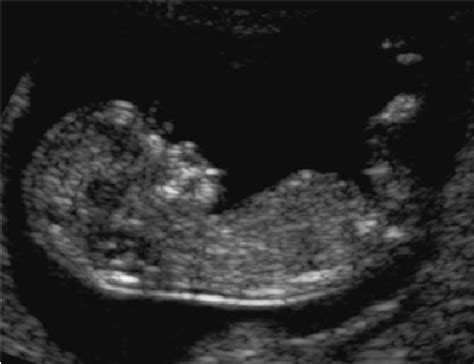 Ultrasound Picture Of A Fetus At 124 Weeks Gestational Age With A