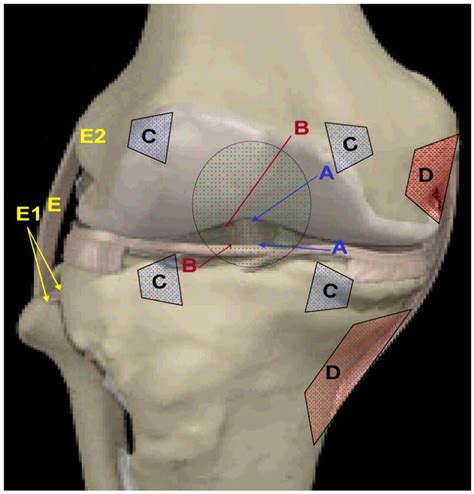 Ligament Tear Knee Injury Cruciate Ligament Tear