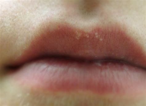 👉 White Spots On Lips Pictures Treatment And Causes January 2022