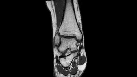 Mri Of A Normal Ankle Complete Mri Examination Youtube