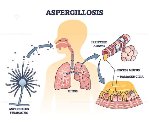 Aspergillosis Lung Infection Caused By Aspergillus Vector Outline