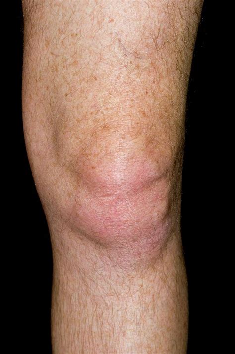 Gout Of The Knee Photograph By Dr P Marazzi Science Photo Library