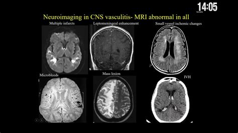 Dr P N Sylaja Diagnosis And Treatment Of Primary Cns Vasculitis