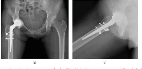 Figure 3 From Total Hip Arthroplasty After Treatment Of Pseudojoint