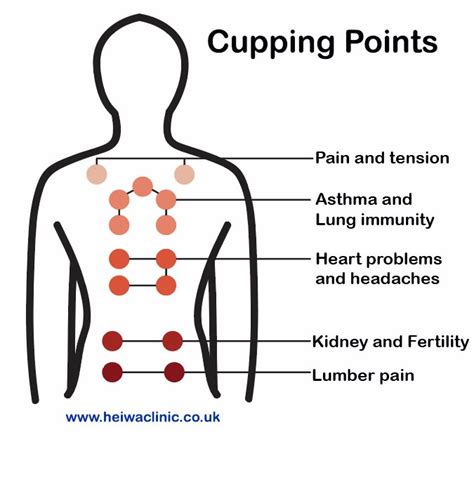 Cupping Therapy For Better Health Fareham Acupuncture Kinesiology Moxibustion Cupping