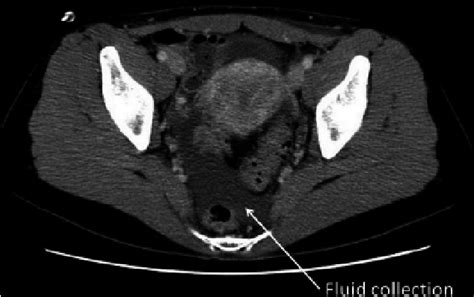 A Contrast Enhanced Ct Scan Shows A Little Ascites At Pelvic Space