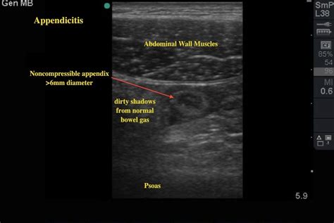 Ultrasound For Appendicitis Ultrasound Cases Info