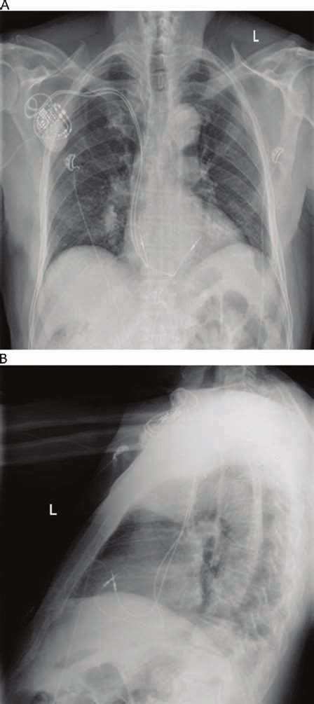 Chest Radiograph Of A Dual Chamber Pacemaker Implanted With Right