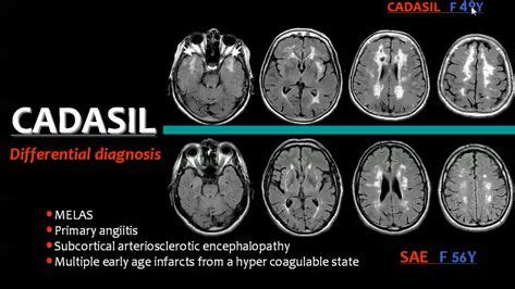 From the pathologic point of view, wm diseases can be classified into three major groups: White matter diseases | Radiology, Neurology, Mri brain