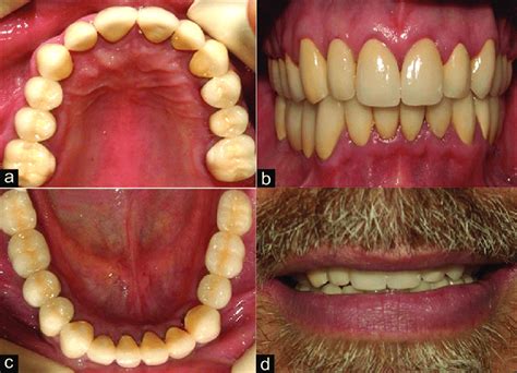 Clinical View Of Post Treatment Dentition A B Occlusal Views Of