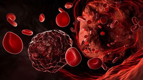 10 Best Blood Cancer Treatments In The World Health Lar