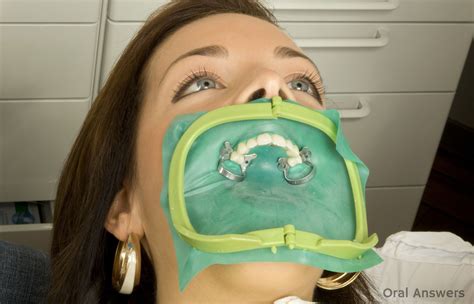 rubber dental dams what they are and why dentists use them dental dentist dam