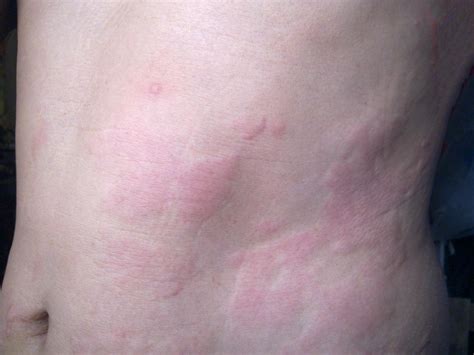 Stress Rash Effects Treatment And Alternative Causes