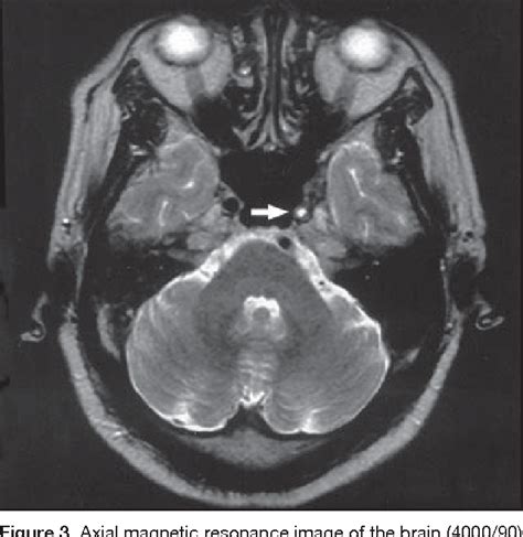 Figure 3 From Carotid Artery Occlusion In A Patient With Intracranial