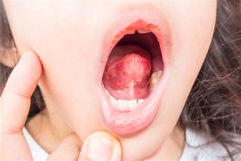 Tongue Disease Health Clues Hiding On Your Tongue The Healthy