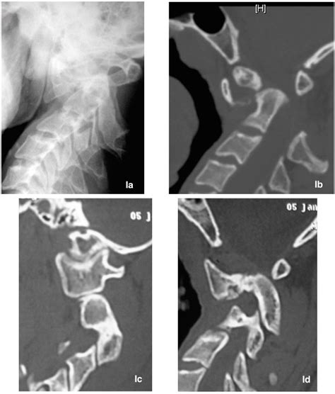 A Lateral X Ray Of Cervical Spine Showing Atlantoaxial Dislo Cation