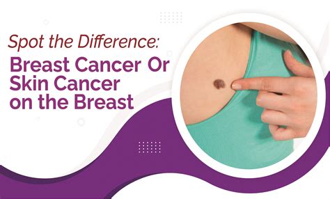 Spot The Difference Breast Cancer Or Skin Cancer On The Breast