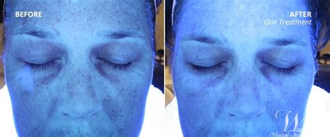 Hydrafacial Md® Before And After Photo Gallery The Woodlands Tx
