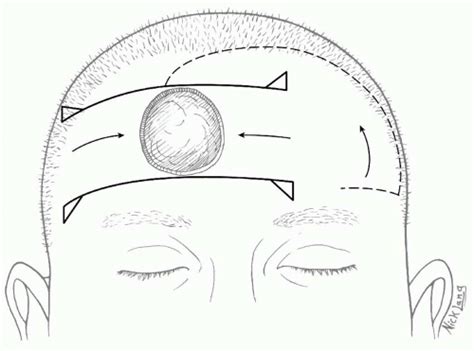 Reconstruction Of The Scalp Calvarium And Forehead Plastic Surgery Key