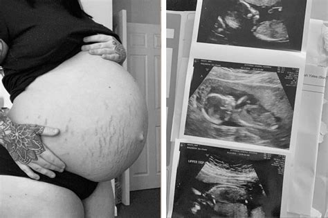 Mum Falls Pregnant With Triplets While On The Pill