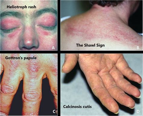 Dermatomyositis Medical Junction