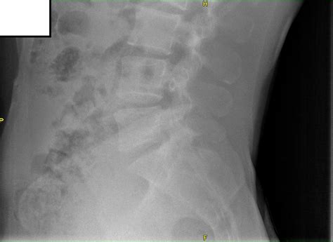 I have lower back dull pain on right side of spine close ...