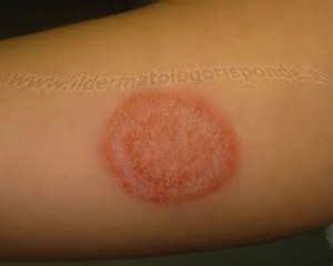 A, based on multiple randomized controlled trials rcts). Boring Question: Steroids for Tinea? - CanadiEM