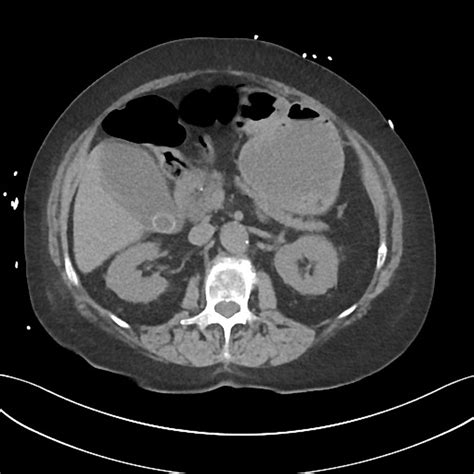 Cholangitis Ultrasound