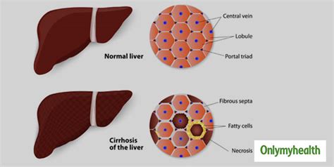 Primary Biliary Cirrhosis Pbc Signs Causes Diagnosis And Treatment