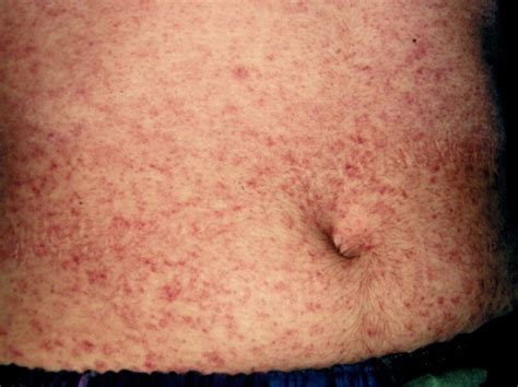 Figure Measles Infection Dermnet New Zealand Statpearls Ncbi