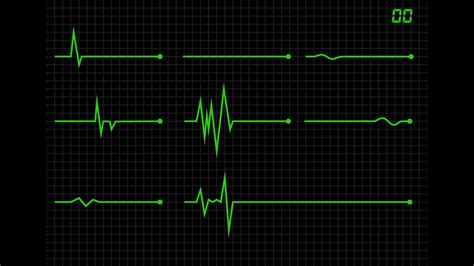 How A Heart Beat Flat Line Looks Like Ecg Flat Line Youtube