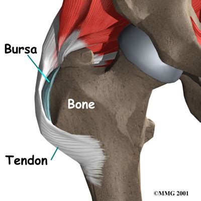 Gluteal Tendinopathy Physiotherapy Manly