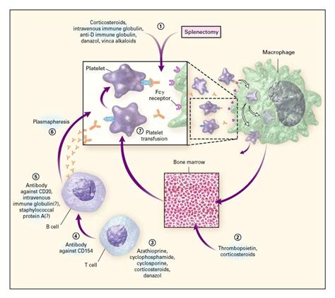 Immune Thrombocytopenic Purpura Nejm