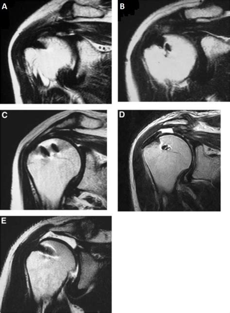 Figure 1 From Intra And Inter Observer Agreement In MRI Assessment Of