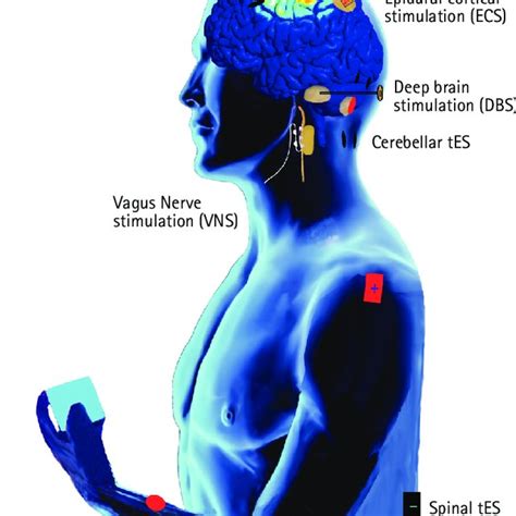 Typical Electrical Stimulation Modalities For Post Stroke Motor