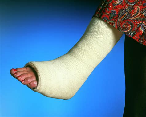 Plaster Cast On The Broken Leg Of A Woman Photograph By Simon Fraserscience Photo Library Pixels
