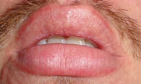 Any Suggestions At Peeling Lips Exfoliative Cheilitis With Image