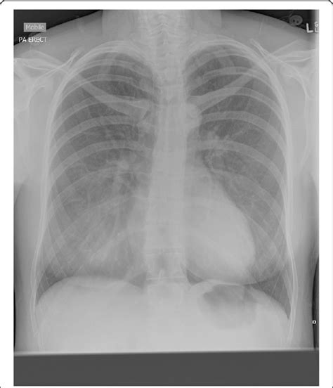 Chest X Ray Demonstrating Subcutaneous Emphysema And Pneumomediastinum