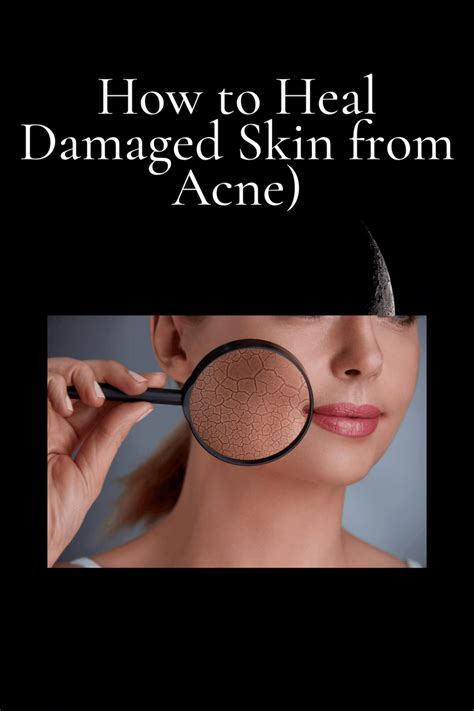 How To Heal Damaged Skin From Acne Fast Life Tips