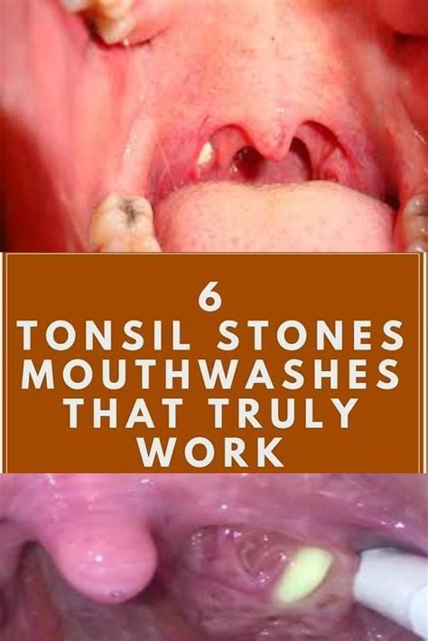 How Do You Remove Tonsil Stones Tonsil Stones Also Called