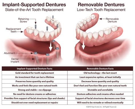 Fixed Dentures Chattanooga Center For Comprehensive Dentistry