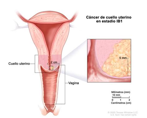 Tratamiento Del C Ncer De Cuello Uterino Patients Oncolink