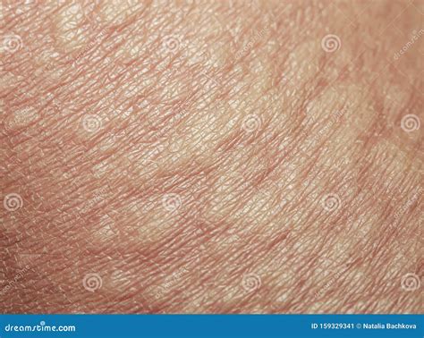 Texture Unhealthy Irritated Human Skin Is Covered With Fine Wrinkles