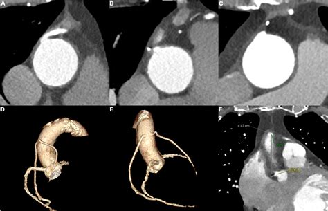 Frontiers Coronary Cta Would Facilitate Invasive Angiography In