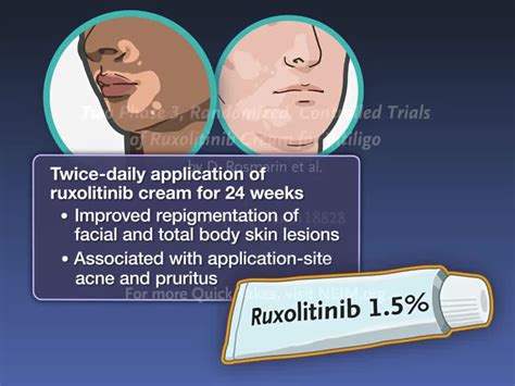 Rutinib Cream Ruxolitinib Vitiligo Cream For Personal Packaging Size