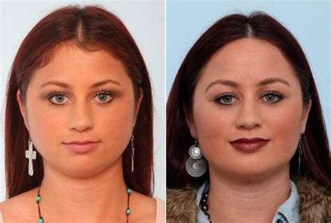 Patient 27866 Buccal Fat Pad Removal Before And After Photos In 2024